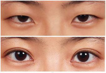 雙眼皮如何變單眼皮？